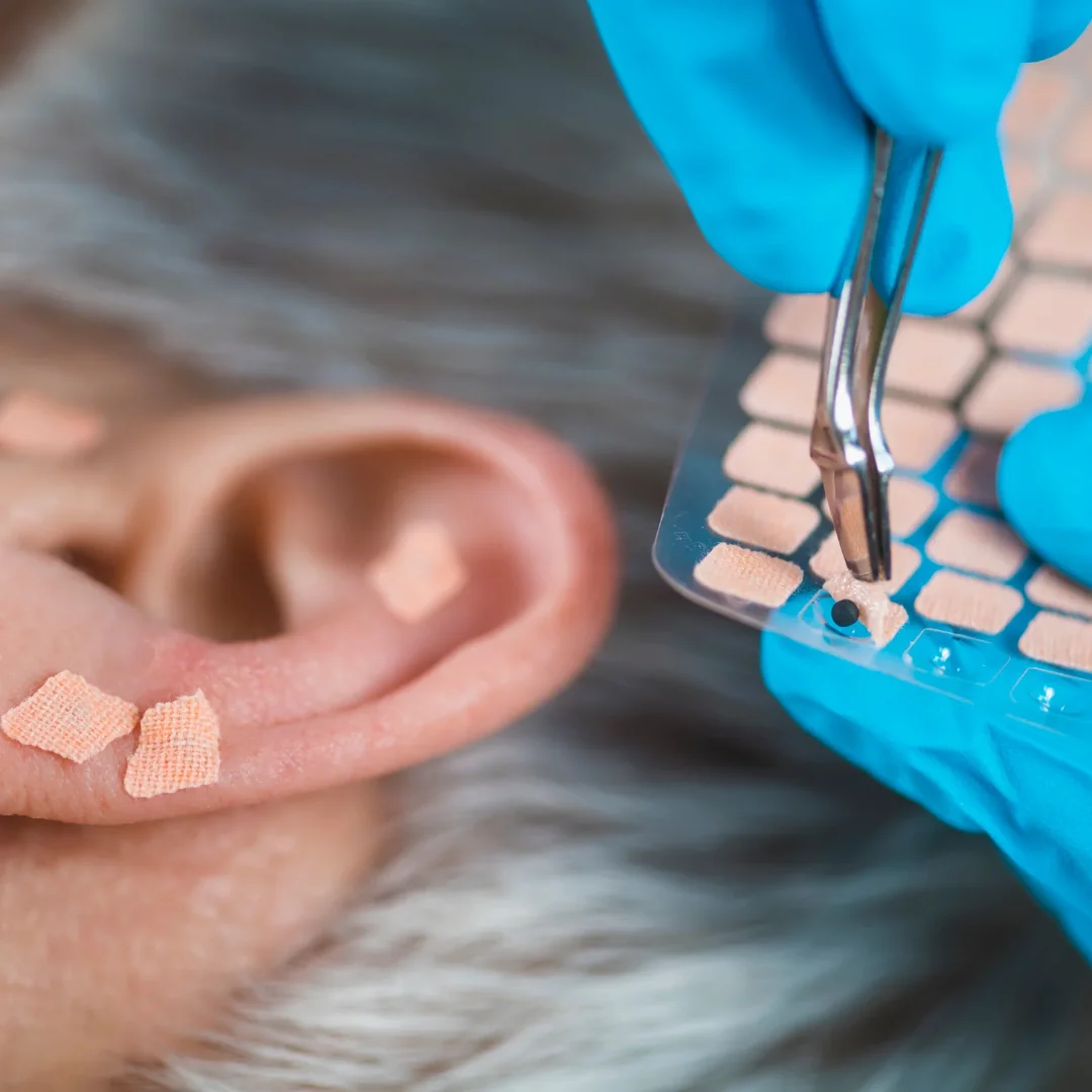 A close-up of an ear having ear seeds applied to acupressure points with tweezers by a gloved hand
